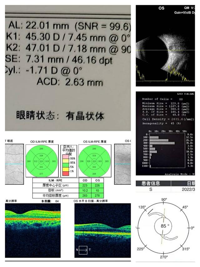 白内障手术费用大概多少钱能报销吗（白内障手术费用国家免费多少）