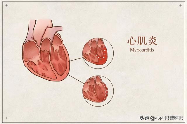 心肌炎症状及表现怎么治疗（心肌炎症状及表现早期症状）