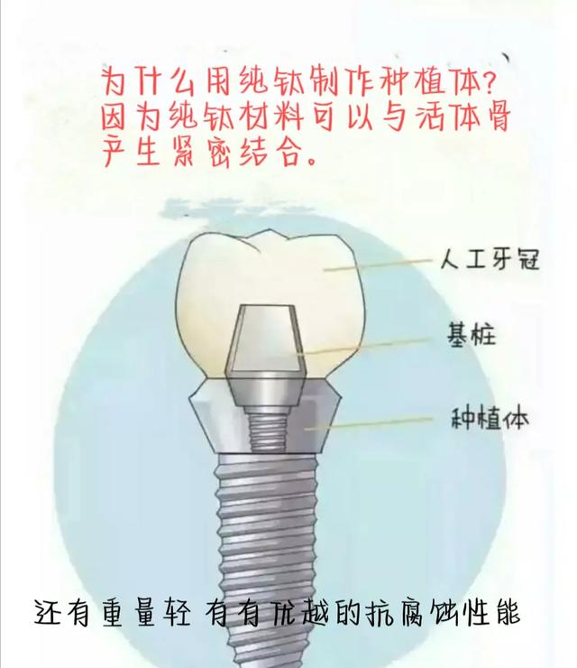 当牙齿缺失时，你选择种植牙还是镶牙呢？关于种植牙的那些事